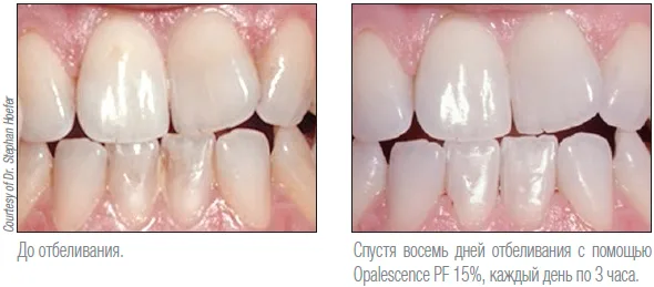 Результат отбеливания Opalescence