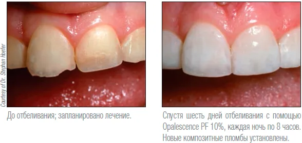 Результат отбеливания Opalescence