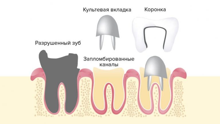 Восстановление культи зуба без штифтов