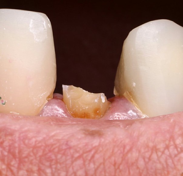 реставрация зуба