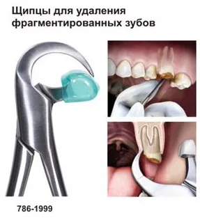 Щипцы 786-1999, Surgicon - для удаления фрагментированных зубов