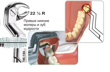 Щипцы №22 1/2 R, Surgicon - для удаления моляров и зуба мудрости нижней челюсти правые