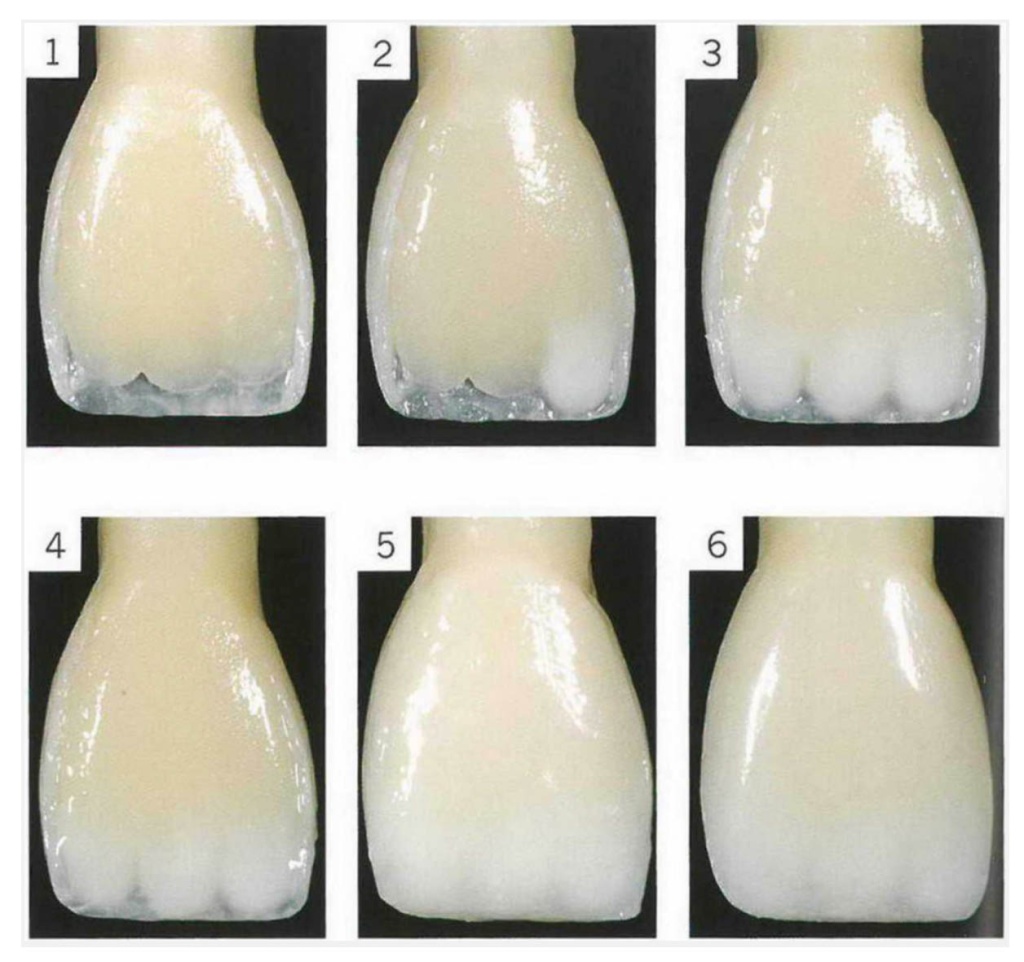 Этапы формирования зуба при помощи материала Enamel Plus