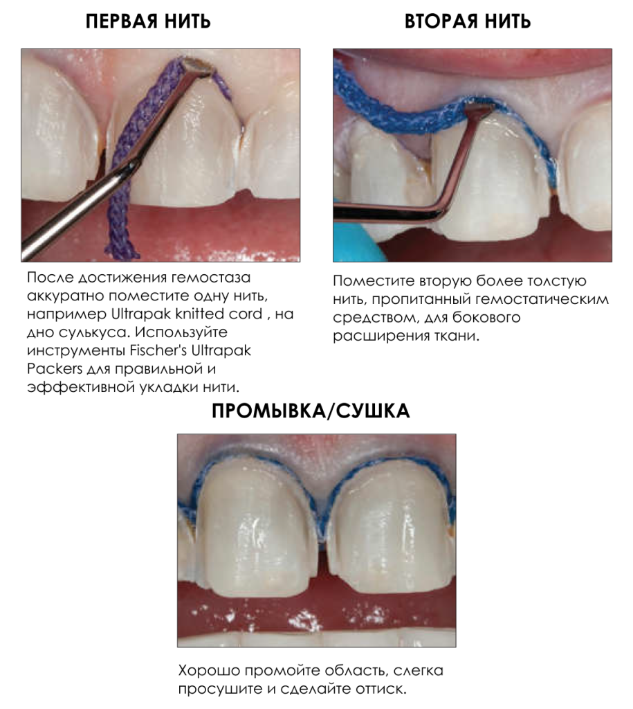 Биоразлагаемые зубные нити для лечения пародонтита