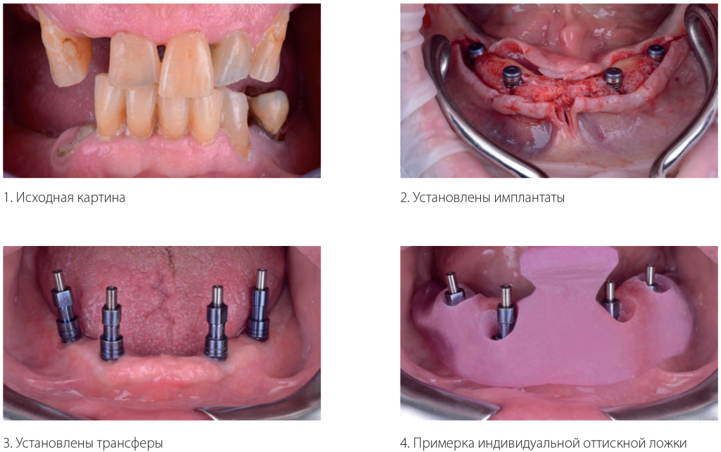 Клинический случай полной реконструкции зубных дуг пациента