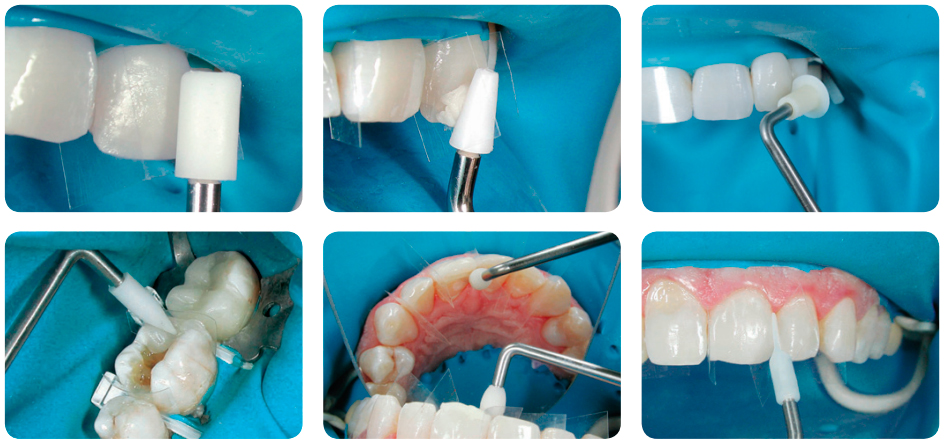 CompoRoller Assorted Kit применение