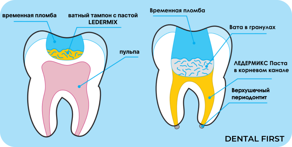 Ледермикс применение