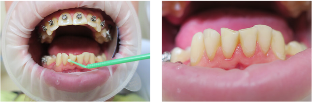 Нанесение адгезива на зубы