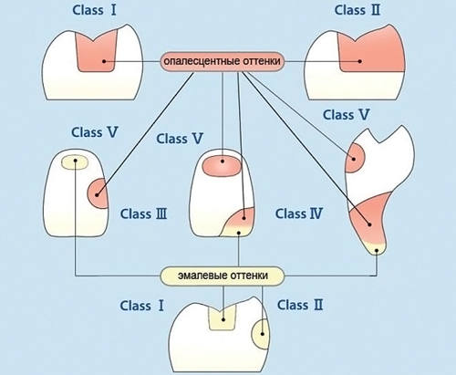 Эстелайт схема построения реставраций