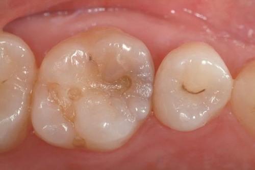 Эстелайт реставрация полостей II класса