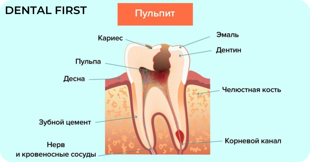 Ледермикс пульпит