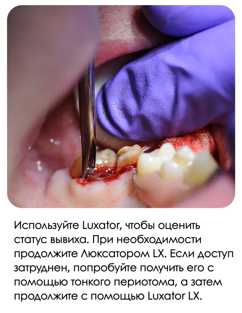 Использование люксатора LX