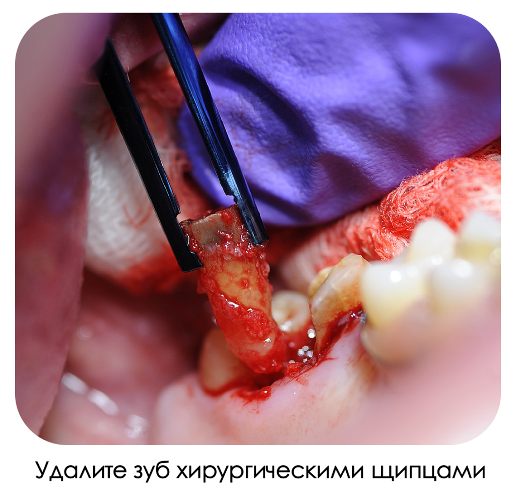 Удалите зуб хирургическими щипцами