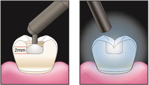 Эстелайт внесение композита и полимеризация