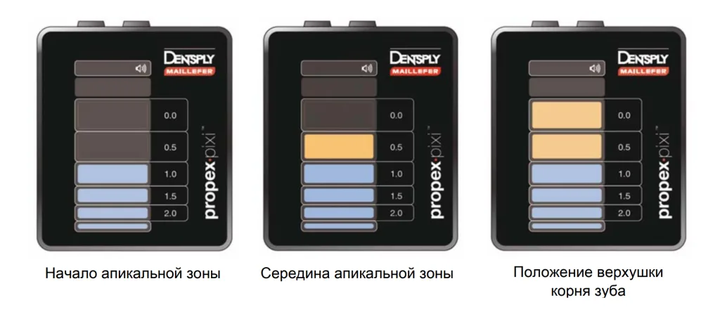 Апекслокатор