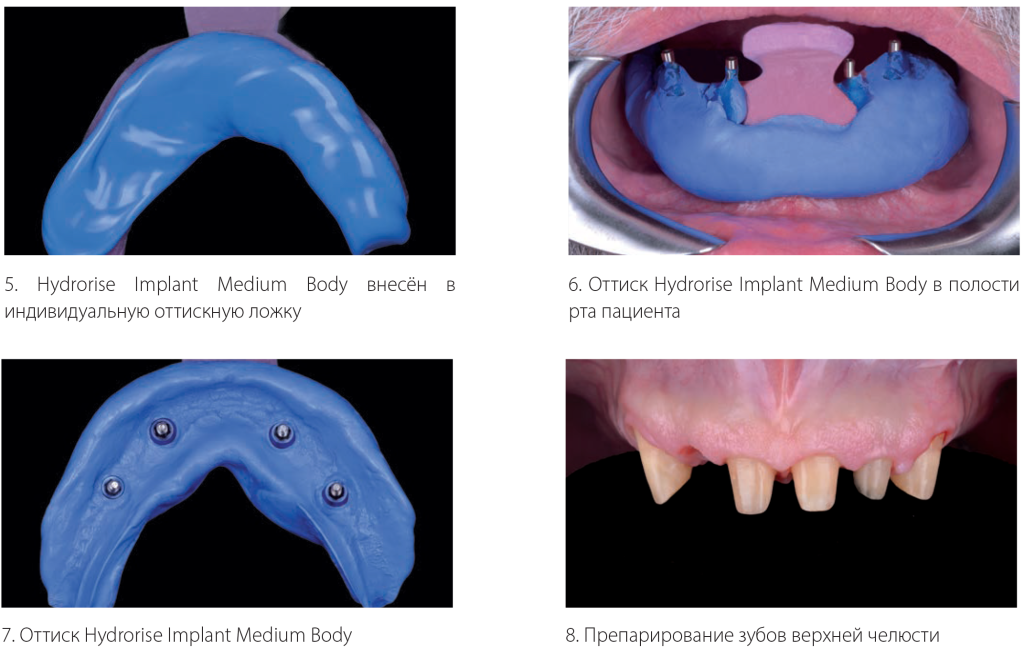 Препарирование зубов в ротовой полости пациента с помощью Hydrorise