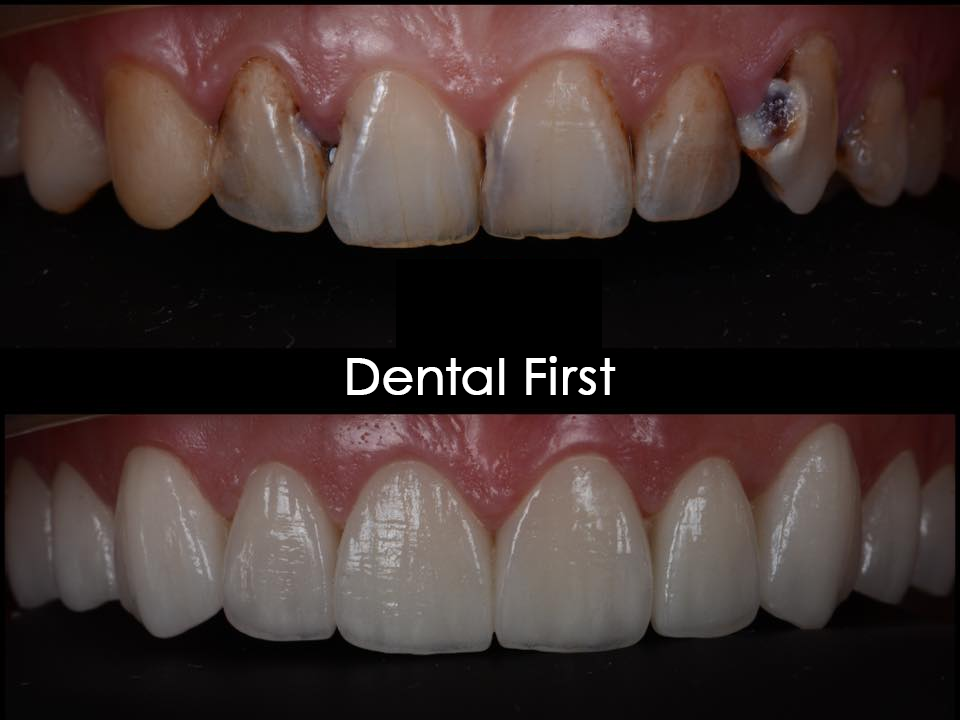Зубы до и после Зубы до и после