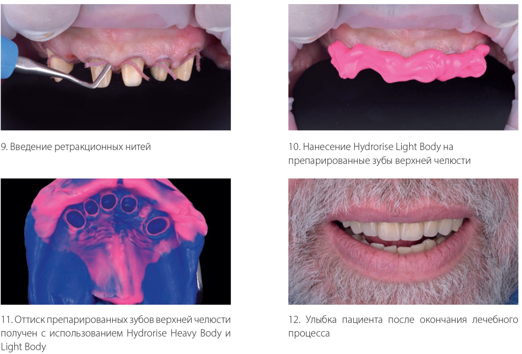 Оттиск препарированных зубов пациента с помощью Hydrorise