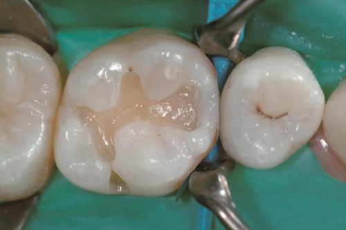 Эстелайт восстановление апроксимальной части