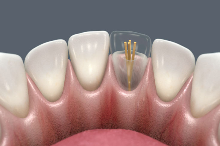 Гуттаперчевые Штифты Гуттаперчевые Штифты