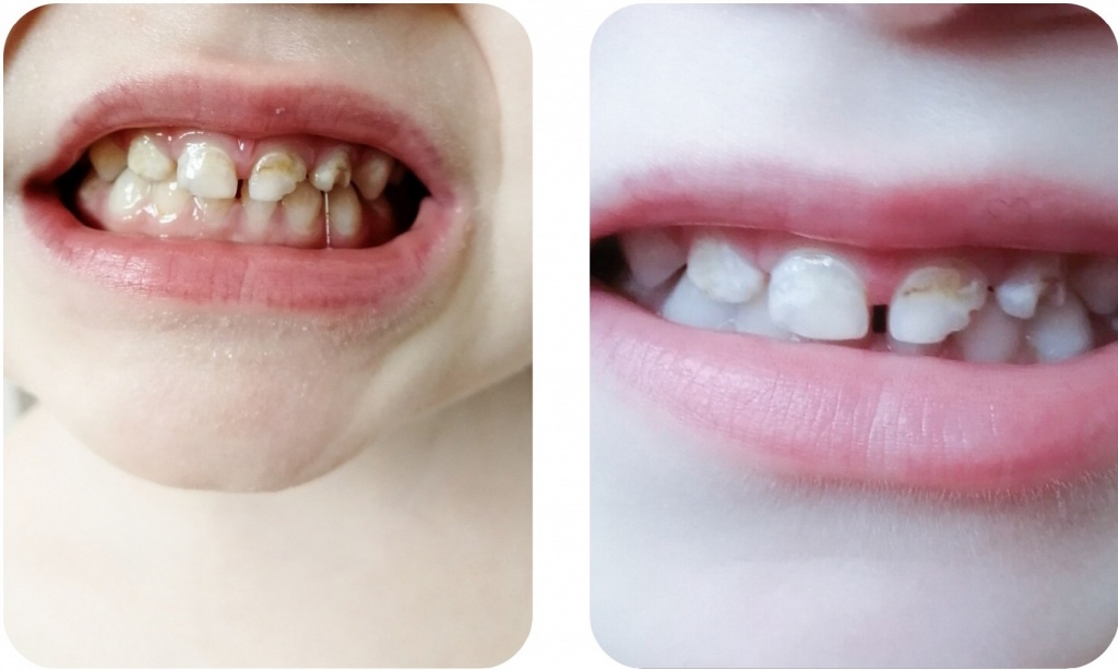 До и после Tooth Mousse.jpg