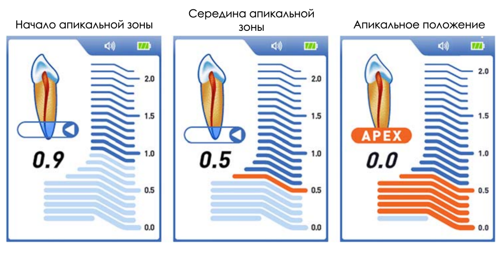 Propex II апикальная зона