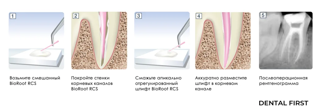 Клиническая реализация BioRoot RCS