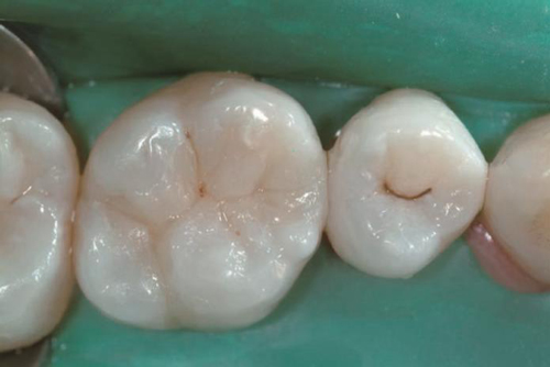 Эстелайт завершение реставрации