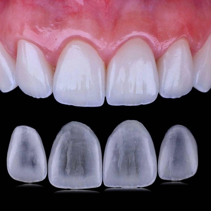 виниры виниры