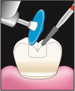 Эстелайт финирование и полировка