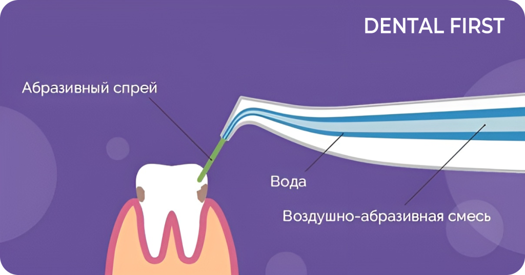 Пескоструйная обработка зубов