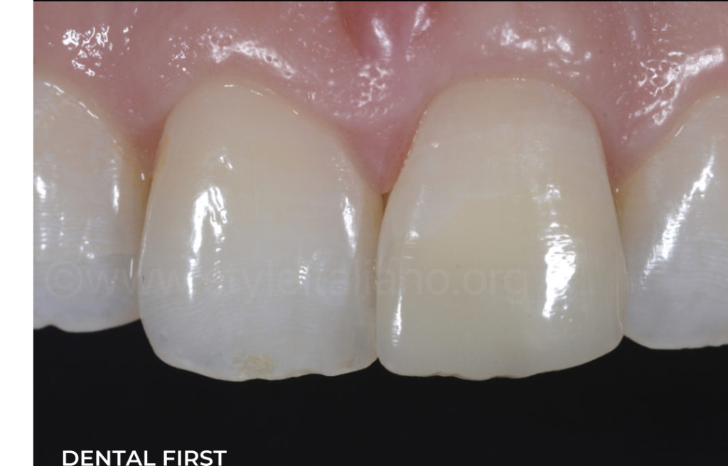 Постоперационный результат, демонстрирующий естественную анатомию зуба и хорошую оптическую интеграцию реставрации.