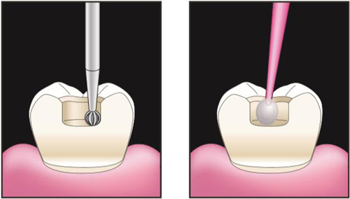 Эстелайт препарирование и бондинг