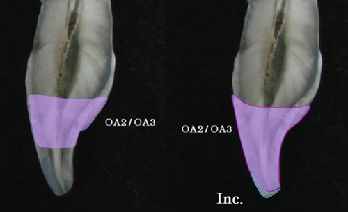 Эстелайт Палфик принцип построения реставрации