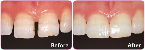 Эстелайт Сигма закрытие диастем