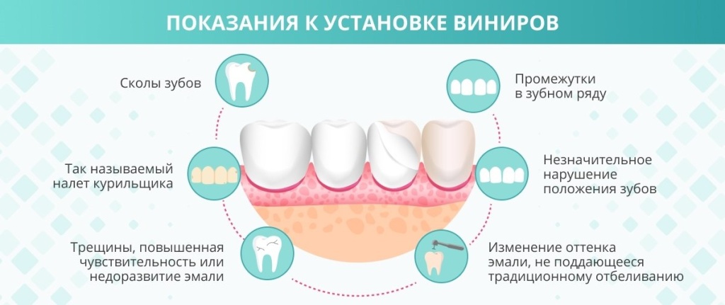 Фиксация виниров