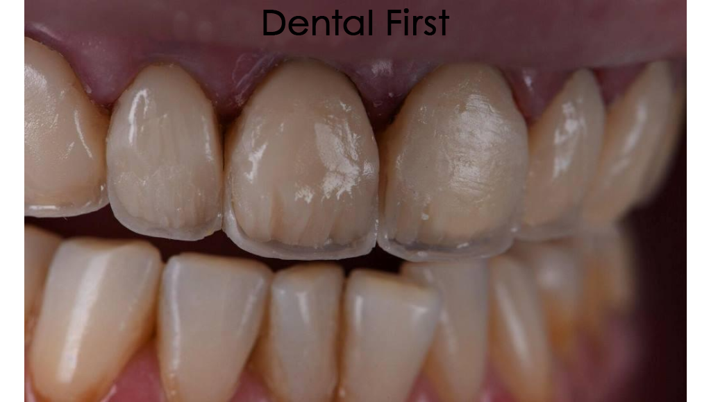 Зубы до лечения Зубы до лечения