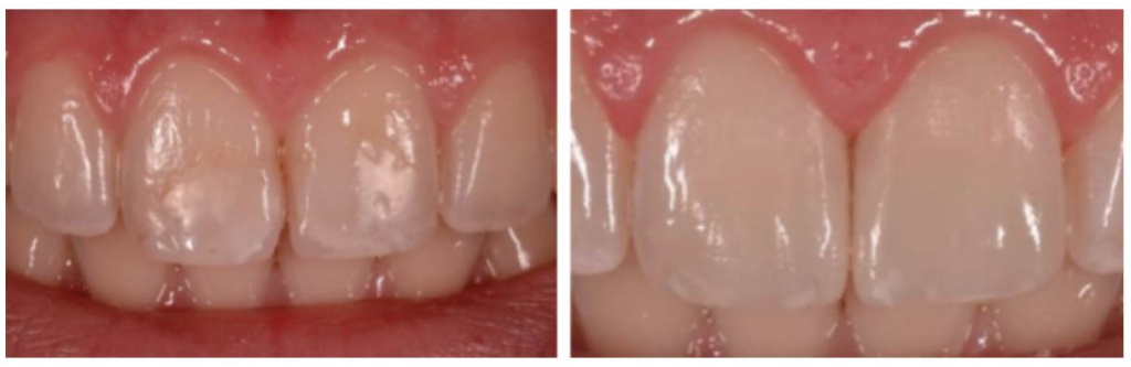 Реставрация зубов с Ename lPlus