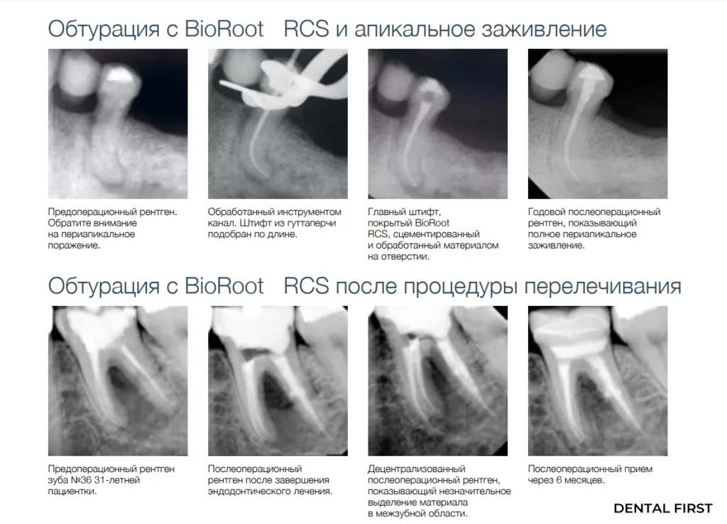 Обтурация с BioRoot RCS и апикальное заживление