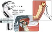 Щипцы №22 1/2 R, Surgicon - для удаления моляров и зуба мудрости нижней челюсти правые