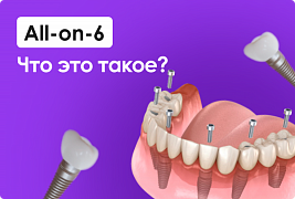 All-on-6 - Что это такое?