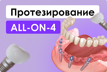 All-on-4 протезирование.